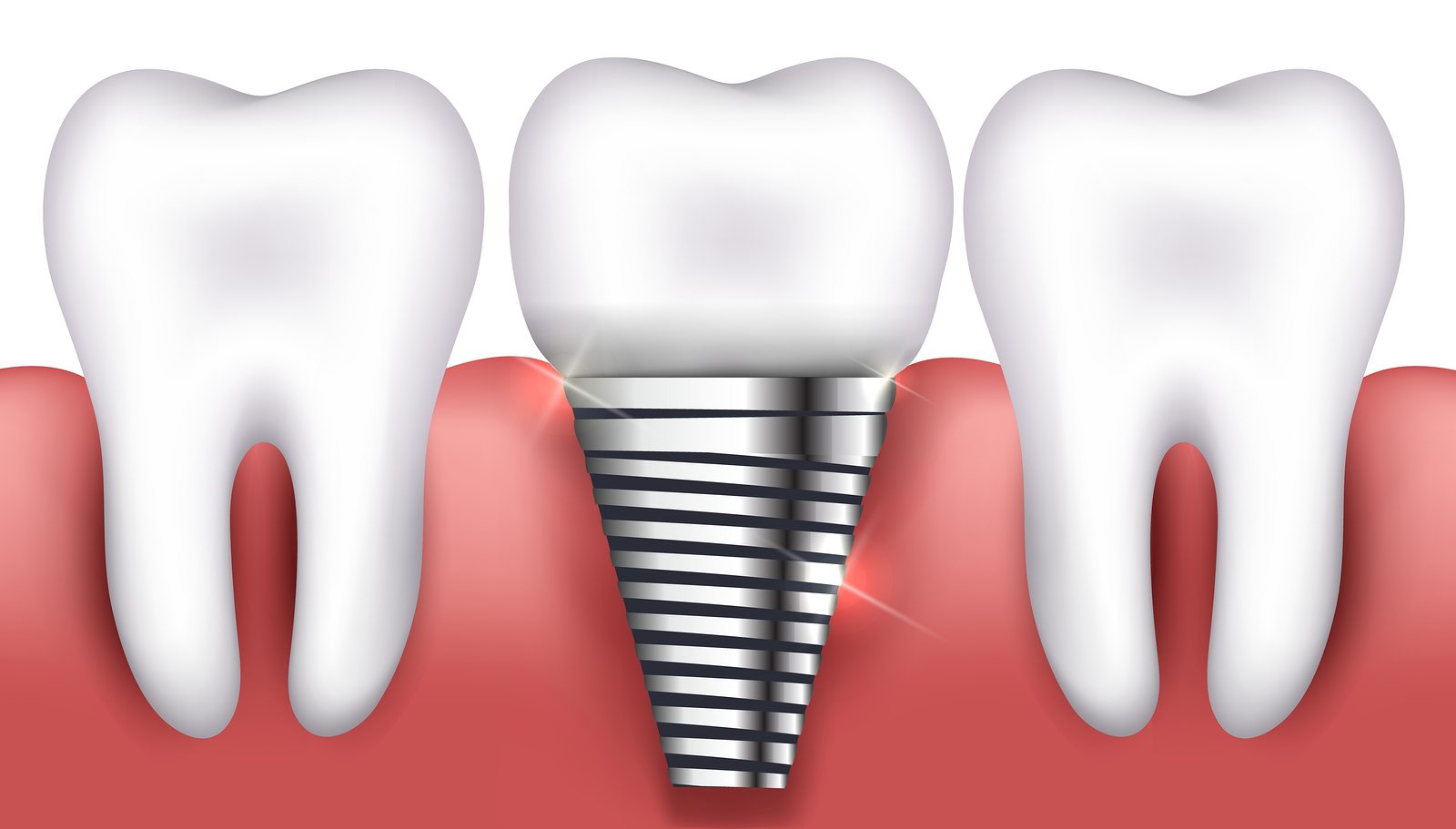 Common Procedures Mint Dental DC