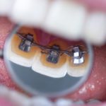 invisible lingual braces on dental mirror